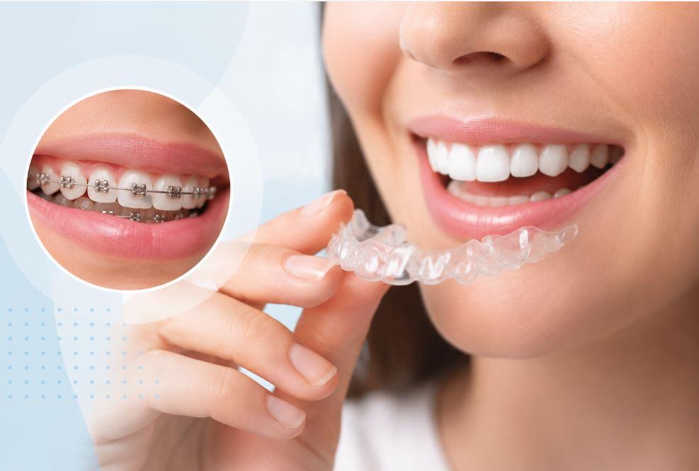 Invisalign ou Aparelho Fixo: Qual Vale Mais a Pena?